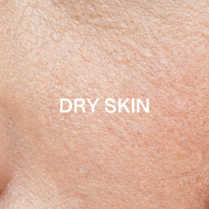 Tørr hud