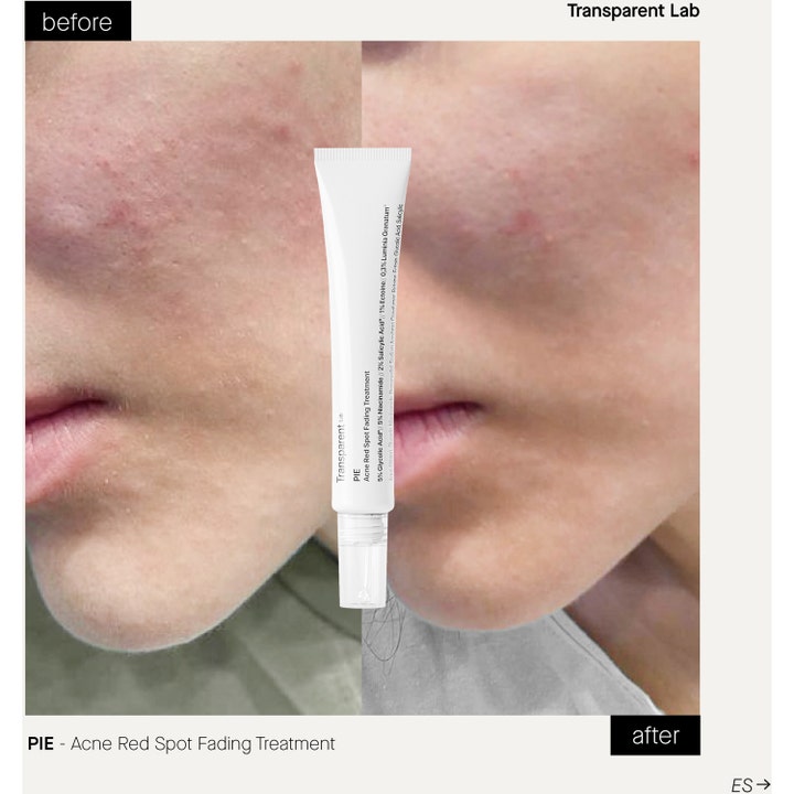 Niche Beauty Lab Transparent Lab P.I.E 30 ml mot rødhet fra kviser i hvit tube med før- og etterbilde.