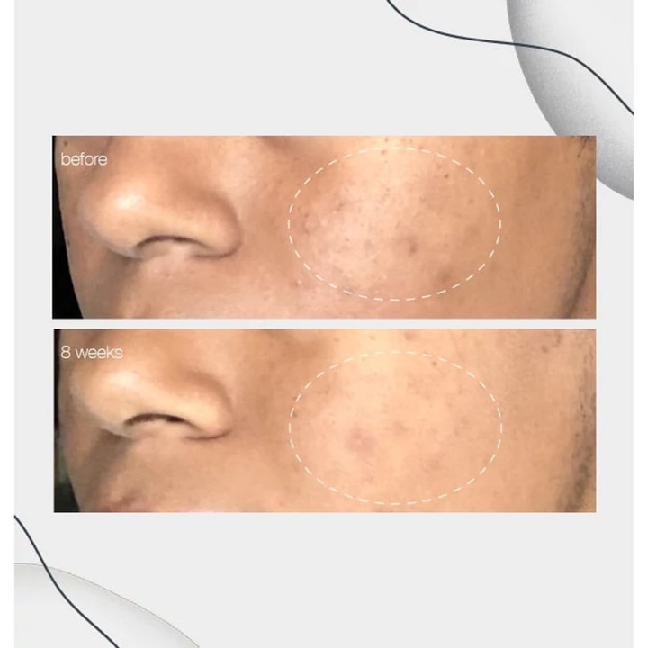 Dermalogica PowerBright Dark Spot Serum 30 ml serum mot pigmentflekker viser før og etter resultat etter 8 ukers bruk