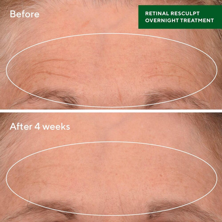Murad Retinal ReSculpt Treatment 30 ml serum viser før og etter 4 uker med synlig reduserte rynker i pannen