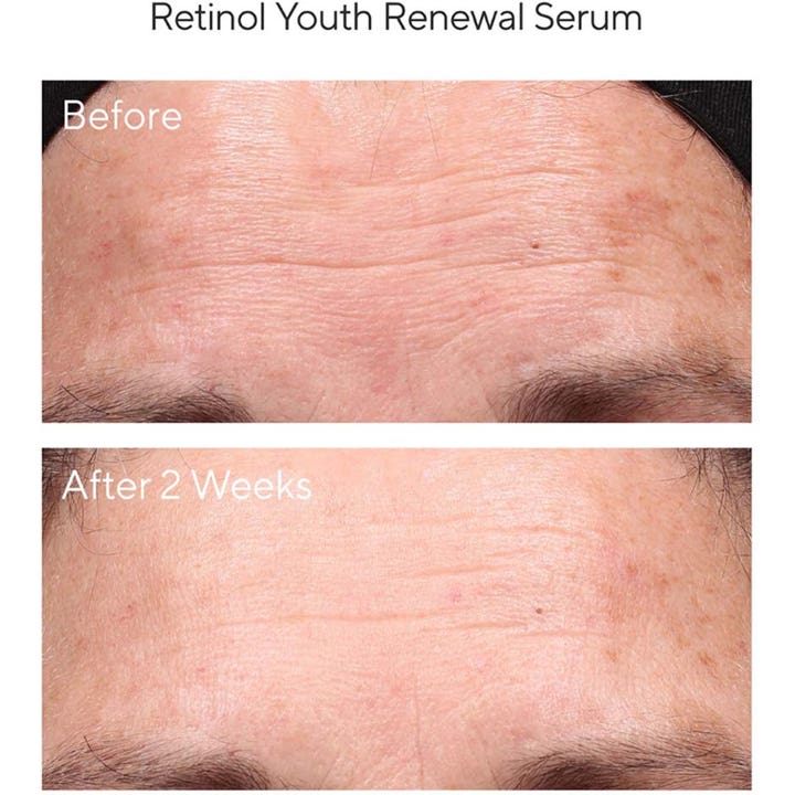 Murad Resurgence Retinol Youth Renewal Serum 30 ml før og etter 2 uker som viser reduserte rynker i pannen