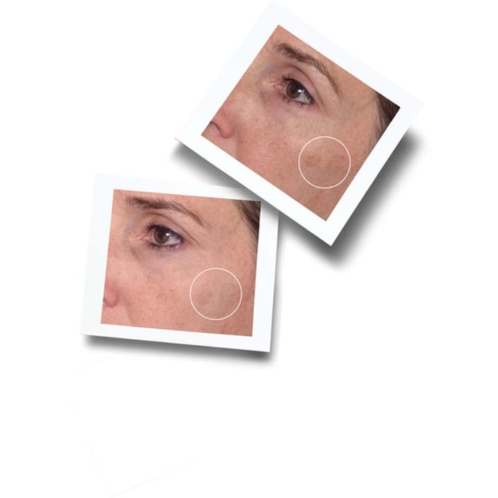Murad Spot Corrector 80 ml mot pigmentflekker vist med før- og etterbilder av mørke flekker på huden.