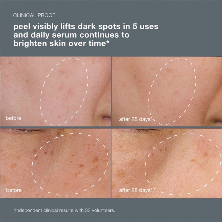 Dermalogica PowerBright Dark Spot System Duo mot pigmentflekker viser kliniske før- og etterbilder på hud.