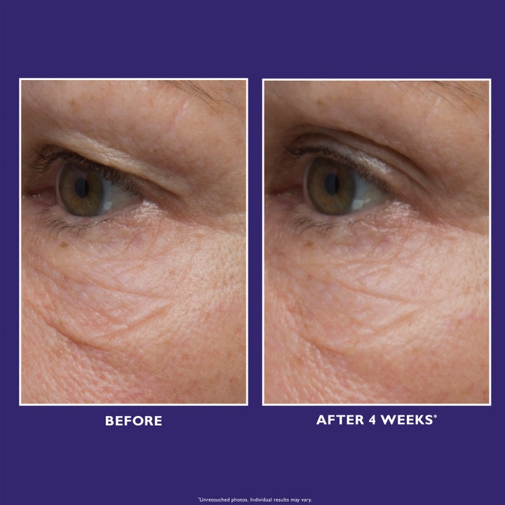 Peter Thomas Roth Ultimate Solution 5 Eye Cream 15 ml øyekrem viser synlig reduksjon av rynker før og etter 4 uker