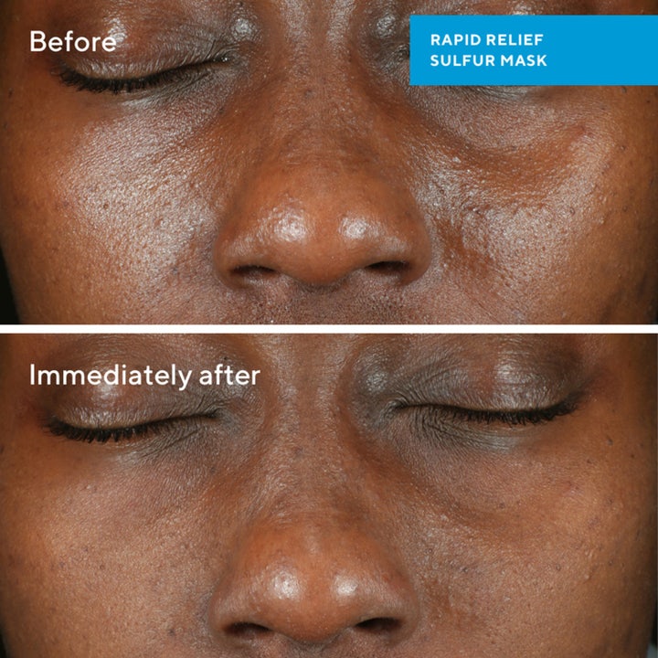 Rapid Relief Sulfur Mask
