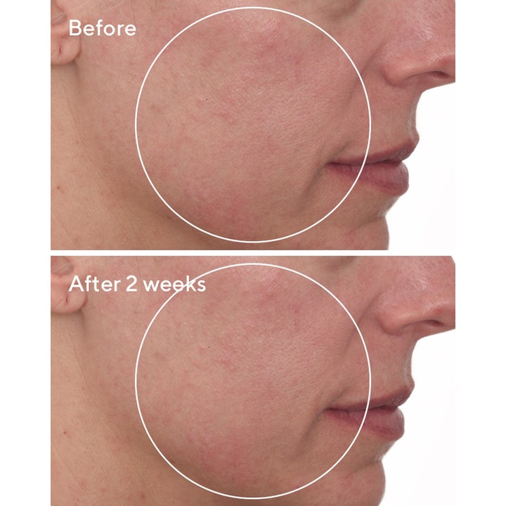 Murad Cellular Hydration Repair Cream 50 ml fuktighetskrem før og etter to uker med redusert rødhet i huden
