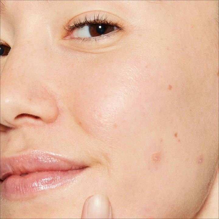 Dermalogica Deep Acne Liquid Patch 15 ml serum for uren hud viser behandling av kviser på et ansikt i nærbilde.