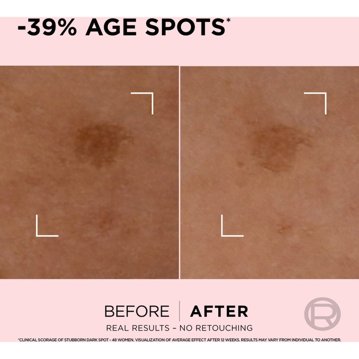 L'Oréal Paris Age Perfect Age Spot Rapid Corrector Serum 30 ml mot pigmentflekker viser før og etter med -39% age spots.
