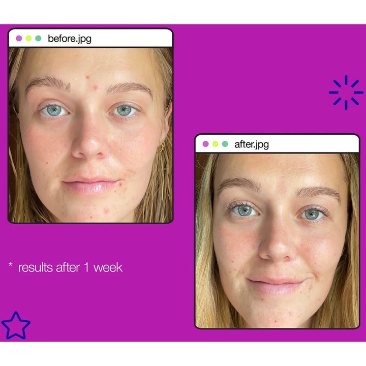 Dermalogica Post-Breakout Fix 15 ml serum før og etter resultat på kvisearr og urenheter etter 1 uke.