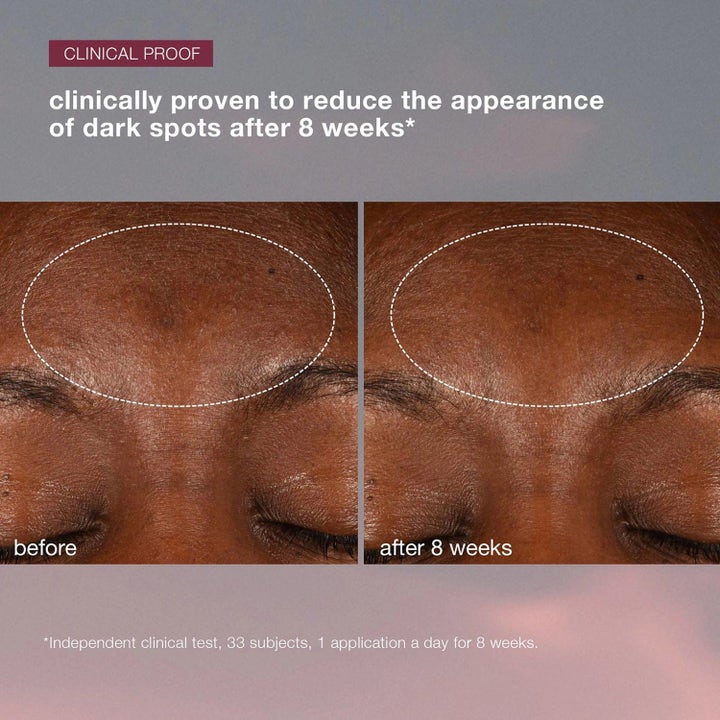 Dermalogica AGE smart Duo Dynamic Skin Recovery SPF50 hudpleie før og etter bilde av reduserte mørke flekker.