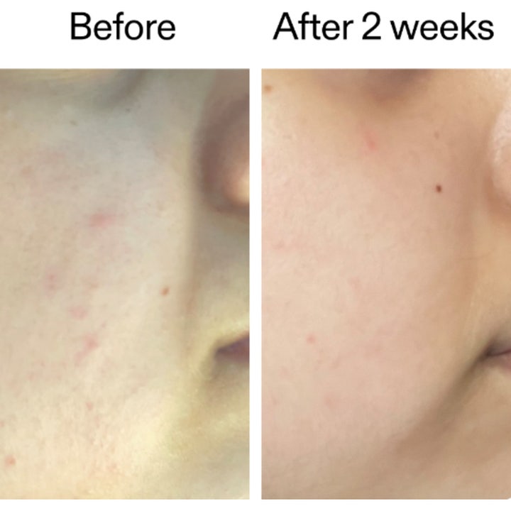 The INKEY List 360 Skin Clearing Serum 30 ml viser hudforbedring før og etter 2 uker med bruk.