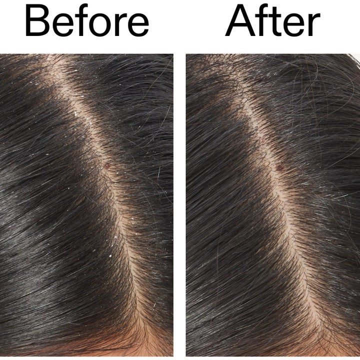 Salicylic Acid Exfoliating Scalp Treatment