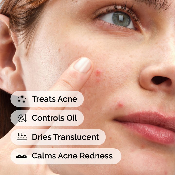 The Ordinary Sulfur 10% Powder-To-Cream Concentrate 5 g spot treatment mot kviser vist på hud med forklarende tekst