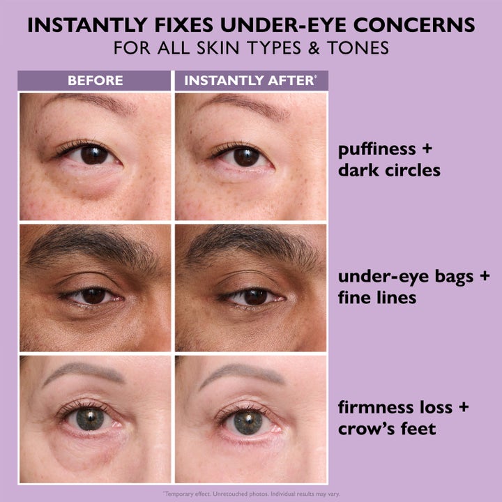 Peter Thomas Roth Instant FIRMx Eye 20 ml øyekrem før og etter bilder som viser reduserte poser og fine linjer