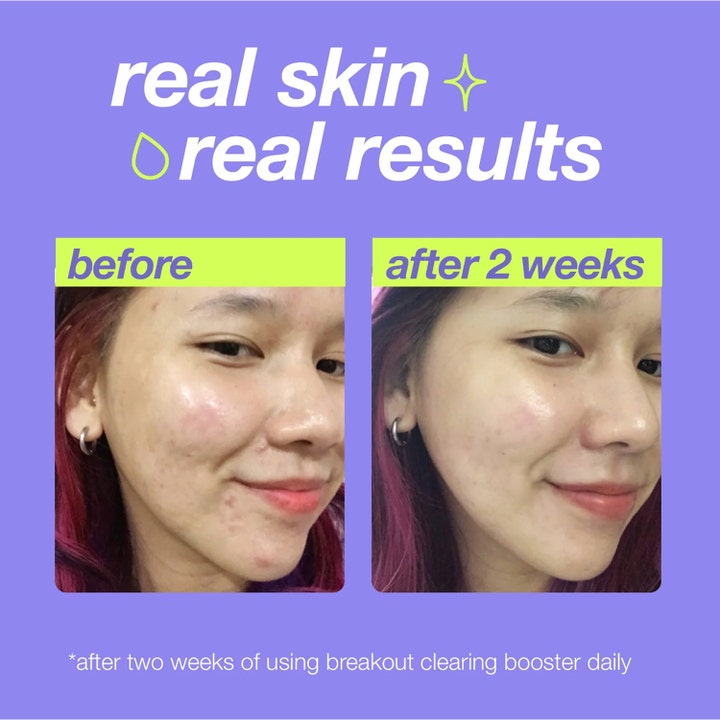 Dermalogica Clear Start Breakout Clearing Booster 30 ml serum mot kviser med før og etter-bilder etter 2 uker