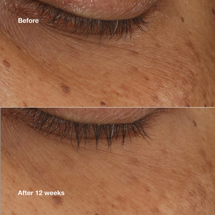 Clinique All About Eyes Brightening Serum Concentrate 10 ml øyeserum viser resultat før og etter 12 uker