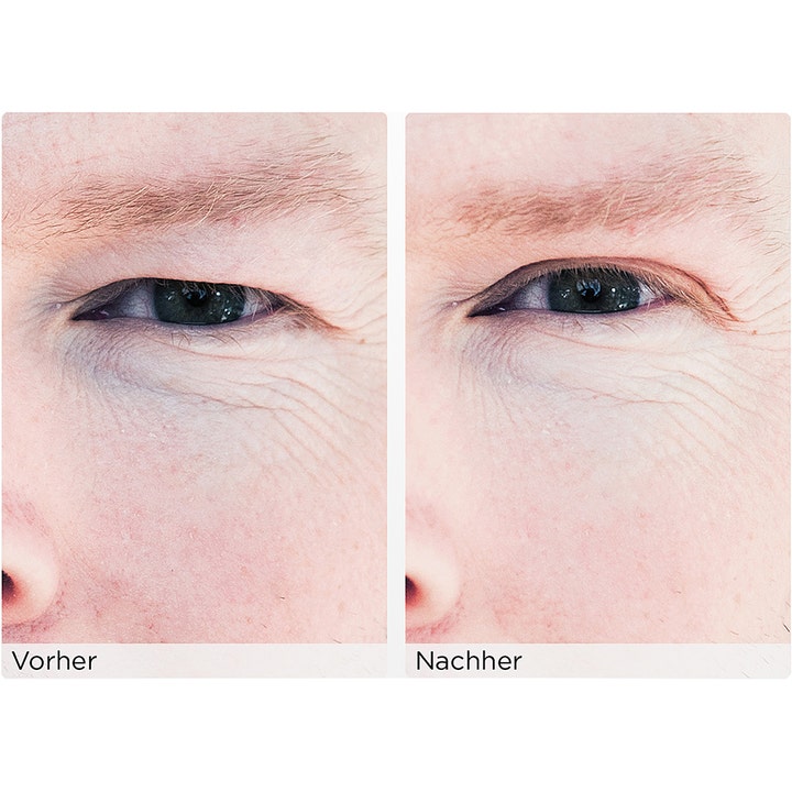 Wonderstripes The Instant Eye Lift Small 64 stk øyeløft tape før og etter bilde som korrigerer tunge øyelokk