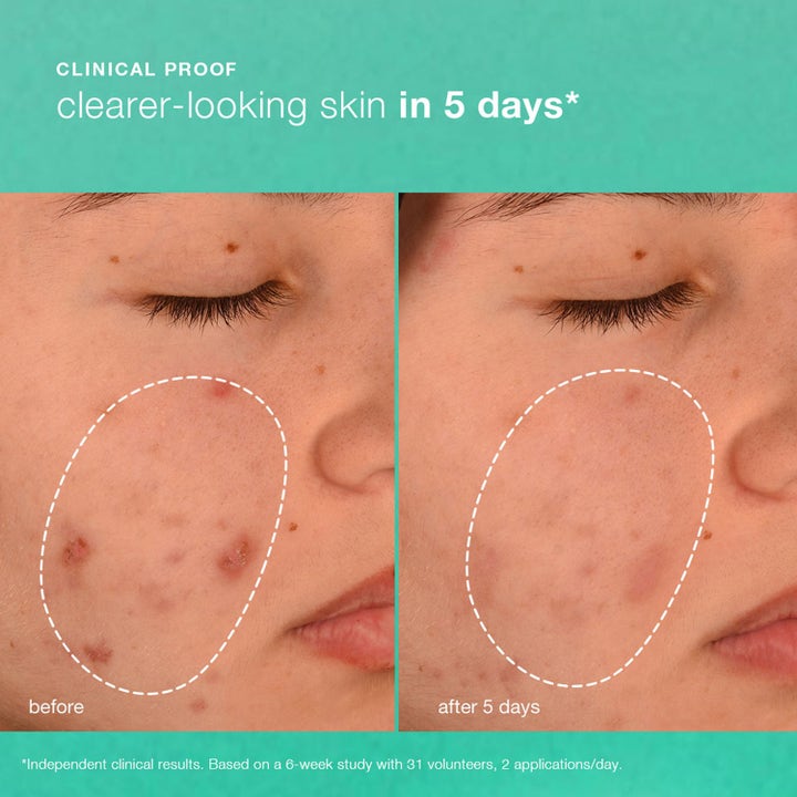 Dermalogica Breakout Biotic Moisturizer 50 ml ansiktskrem viser kliniske før og etter-resultater med klarere hud på 5 dager
