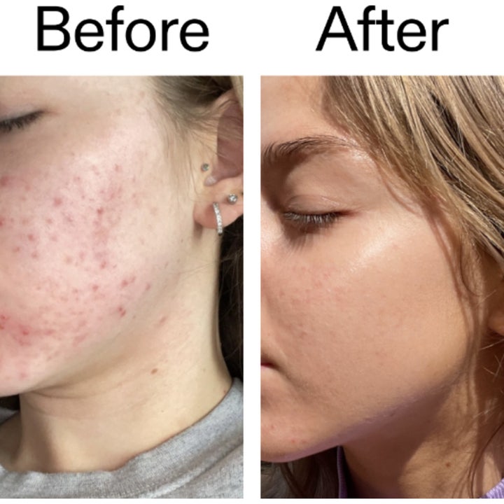 The INKEY List Beta Hydroxy Acid Serum 30 ml renser porer og viser en klar gel som flyter nedover flasken