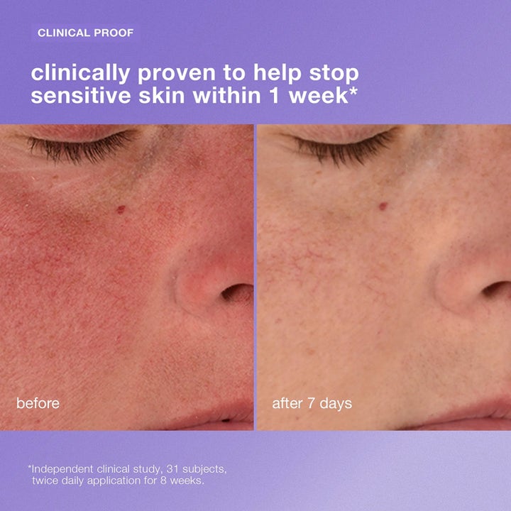 Dermalogica Stabilizing Repair Cream 100 ml ansiktskräm som gir mindre rødhet vist med før- og etterbilde.