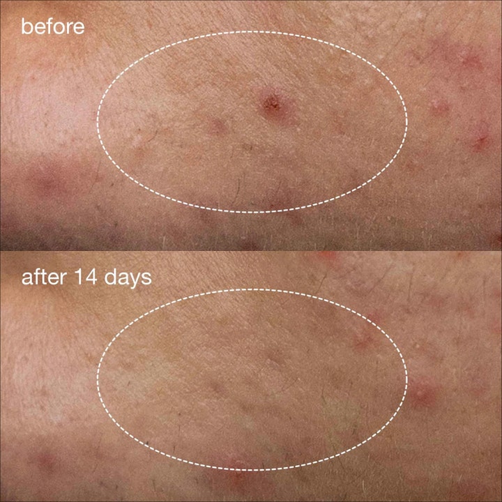 Dermalogica Deep Acne Liquid Patch 15 ml viser før og etter resultater på kviser etter 14 dagers bruk