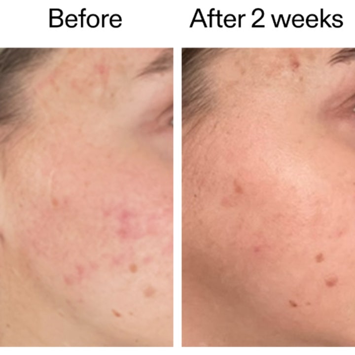 The INKEY List 360 Skin Clearing Serum 30 ml viser før og etter resultater med redusert rødhet og klarere hud etter to uker.
