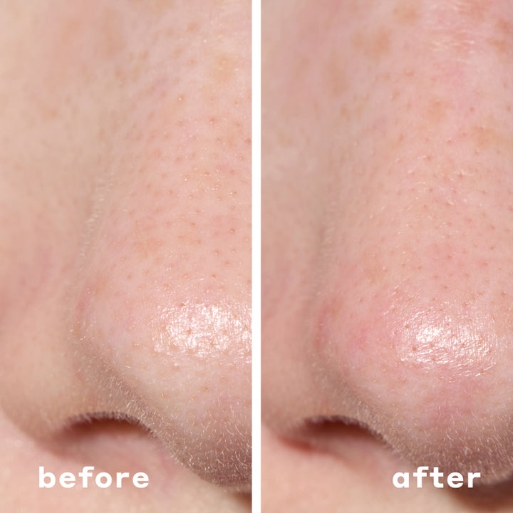 Mario Badescu 2-In-1 Deep Cleansing Pore Strip 6 stk ansiktsrens før og etter resultat som fjerner hudormer på nesen