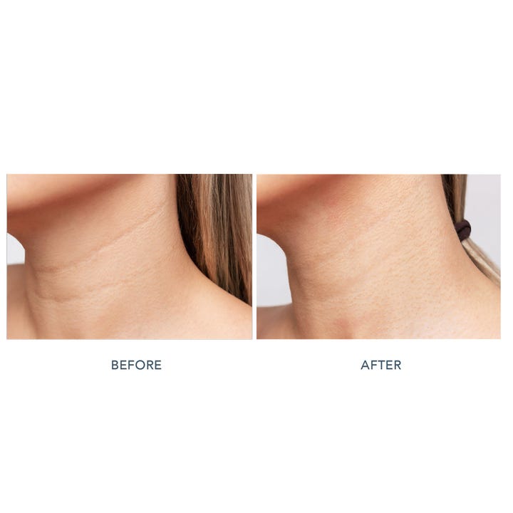 FAQ Swiss FAQ 211 LED Neck & Décolleté Mask 1 stk før og etter resultat som viser glattere hud på halsen