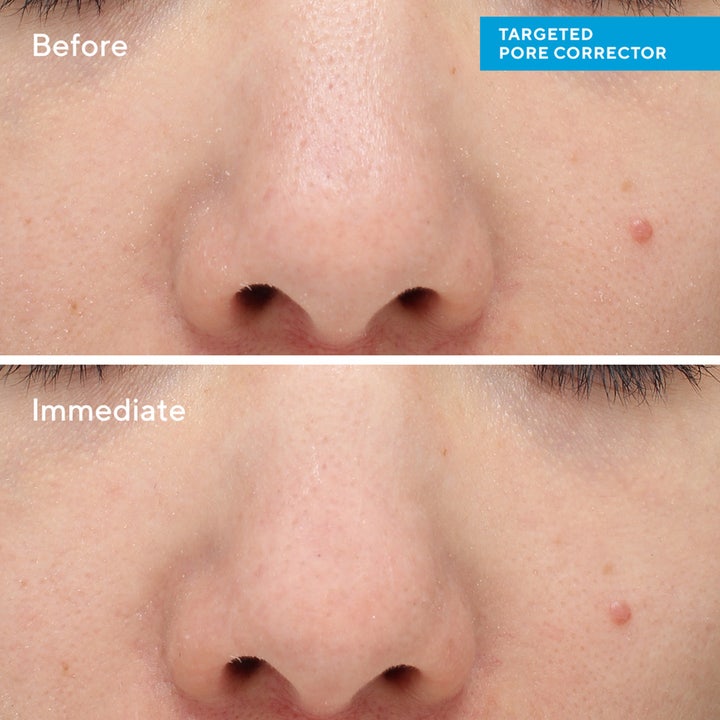 Murad Targeted Pore Corrector 15 ml hudpleie med før og etter resultat som umiddelbart minsker synlige porer.