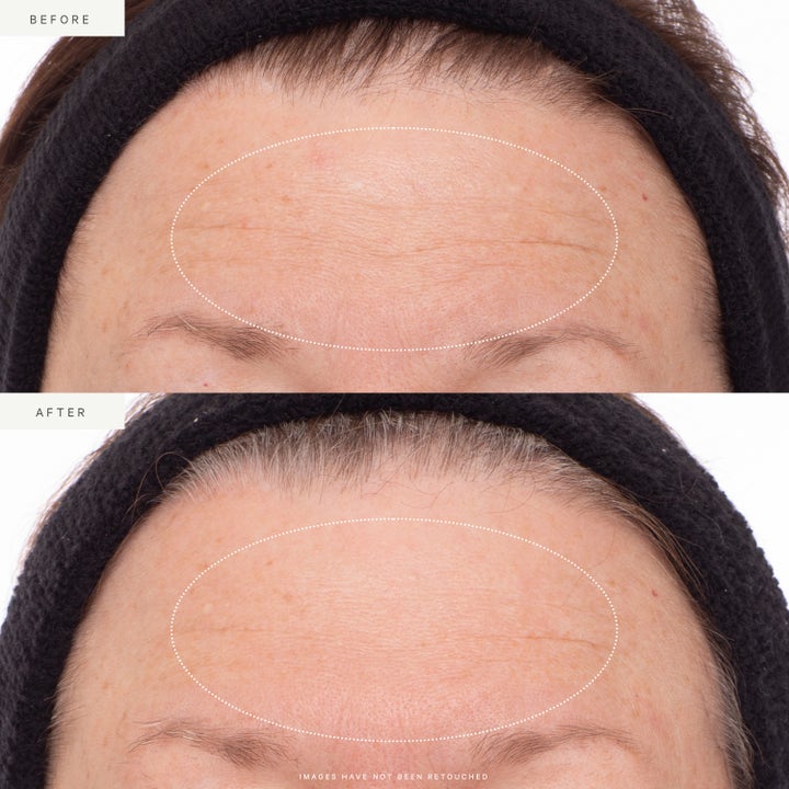 KORA Organics Plant Stem Cell Retinol Alternative Serum 10 ml før og etter bilder som viser glattere hud i pannen