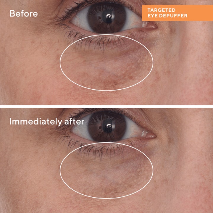 Murad Targeted Eye Depuffer 15 ml øyekrem før og etter bilder som viser redusert hevelse under øyet