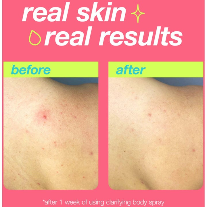 Dermalogica Clarifying Body Spray Duo med salisylsyre viser før og etter-bilder med synlig redusert rødhet og kviser.