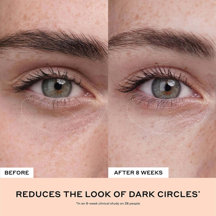 Ole Henriksen Clinical Quick Fix Mini Set 14 ml hudpleie som reduserer mørke ringer vist med før og etter bilder