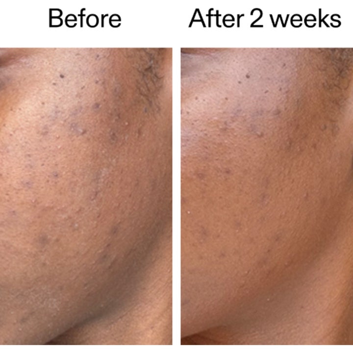 The INKEY List 360 Skin Clearing Serum 30 ml viser før og etter resultat mot kviser og urenheter.