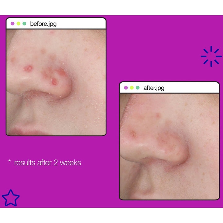 Dermalogica Post-Breakout Fix 15 ml serum mot merker viser før- og etterbilder med reduserte røde merker på en nese