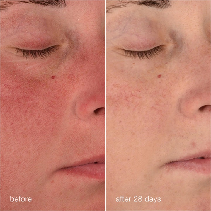 Dermalogica Stabilizing Repair Cream 50 ml beroligende ansiktskrem gir synlig mindre rødhet etter 28 dager.