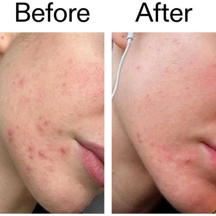 INKEY Blemish Clearing Moisturizer 2% Novoretin