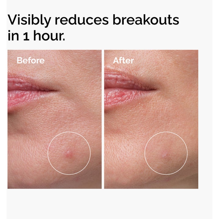 The Ordinary Sulfur 10% Masque 5 g før og etter bilder som viser redusert rødhet og kviser på huden.